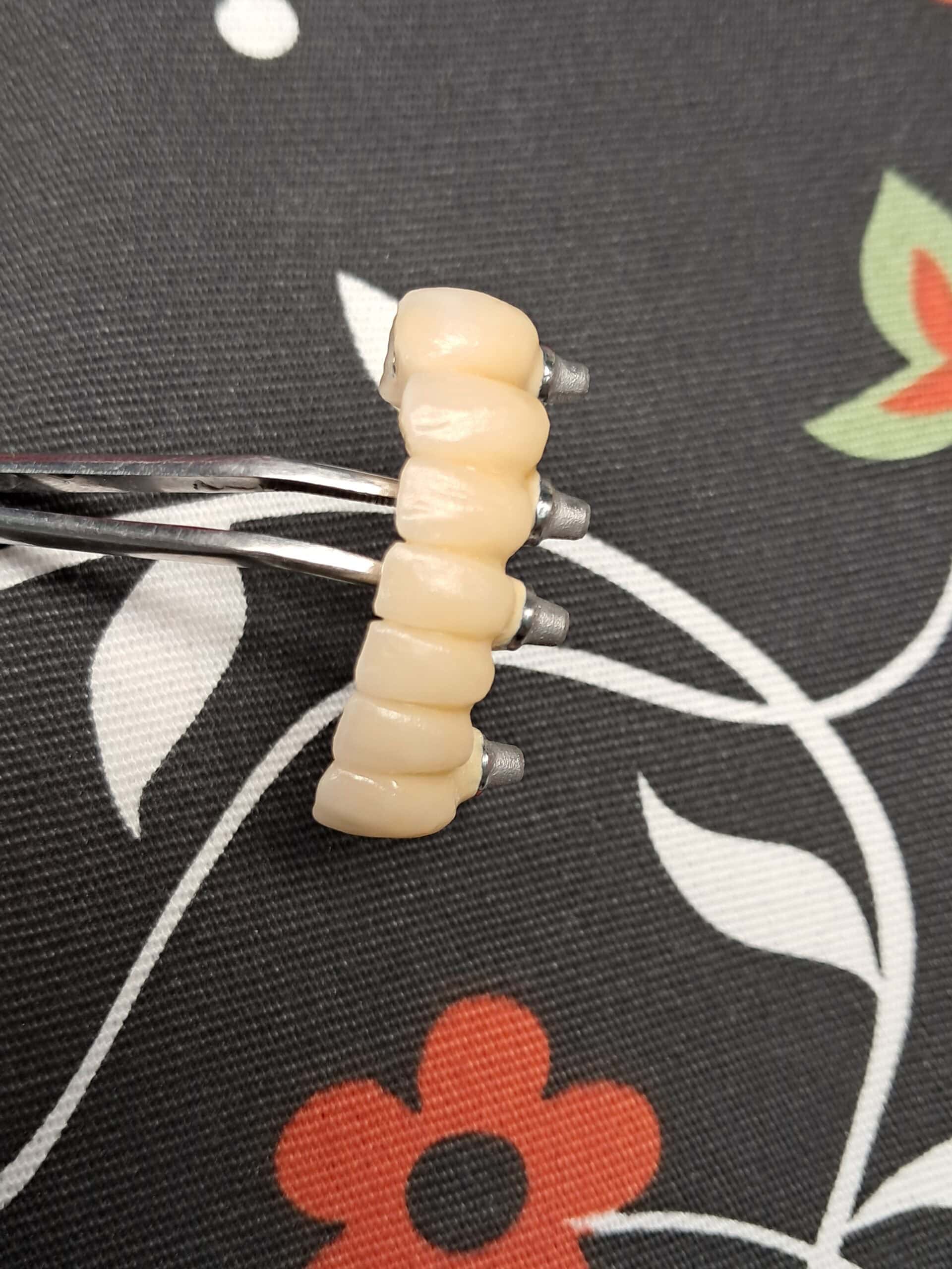 puente-implantes-scaled